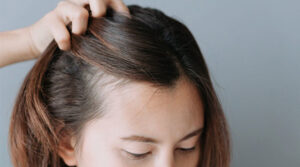 anti-hair fall treatments for postpartum hair loss