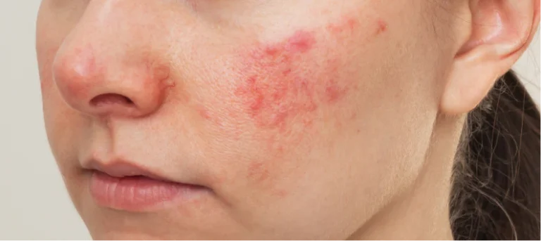 How to Reduce Acne Redness Overnight: Effective and Proven Methods